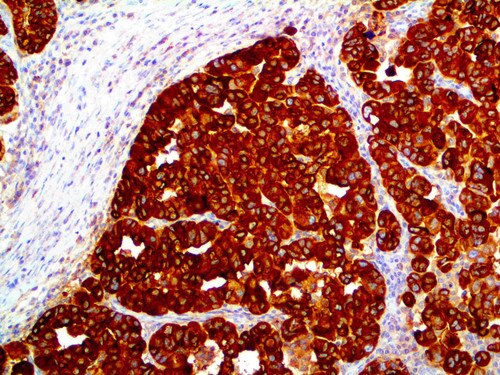 IHC of EMA on an FFPE Ovarian Adenocarcinoma Tissue